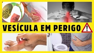 12 SINAIS de que sua VESÍCULA BILIAR está com PROBLEMAS PEDRAS NA VESÍCULA Dr Alain Dutra [upl. by Austin]