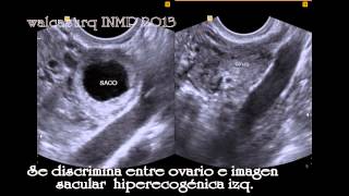 Embarazo ectópico tubárico izquierdo [upl. by Roque]
