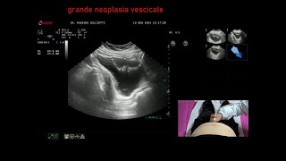 grande neoplasia della vescica [upl. by Aynatan]