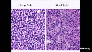 What You Need to Know about NonHodgkins Lymphoma Presentation [upl. by Joellyn]