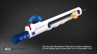 BioSentry™ tract sealant system [upl. by Rubio]