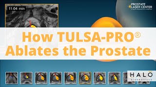 How TULSAPRO TransUrethral Ultrasound Ablation procedure Works as a Prostate Cancer Treatment [upl. by Spearing]