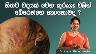 කුරුලෑ වදයෙන් බේරෙන්නෙ කොහොමද   Pimple Treatment Sinhala  Dr Nayani Madarasinghe [upl. by Drofnil]