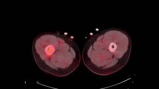 MSK Tumor C9 LCH PET CT [upl. by Ramraj]