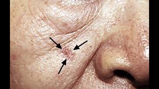 Actinic Keratosis Symptoms and Causes  Diagnosis  Treatment  Prevention [upl. by Nahsez]