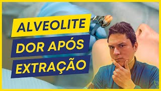 ALVEOLITE  O QUE CAUSA COMO TRATAR [upl. by Essyle]