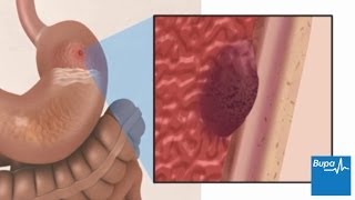 How a peptic ulcer develops  Bupa Health [upl. by Natalie21]