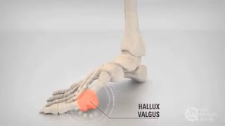 Hallux Valgus [upl. by Kong568]