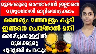 മൂലക്കുരു ഓപ്പറേഷൻ ഇല്ലാതെ മുഴുവനായി മാറ്റിയെടുക്കാം [upl. by Thibault]