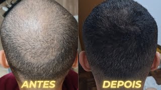 TRATAMENTO PARA CALVICIE MINHA JORNADA RECUPERANDO MEU CABELO  ANTES E DEPOIS  EM ANDAMENTO [upl. by Bigg]