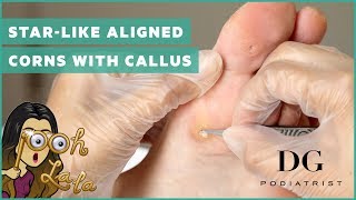 Starlike aligned corns with callus [upl. by Assirehc431]