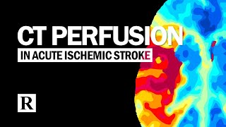 CT Perfusion In Acute Ischemic Stroke [upl. by Dnumyar]