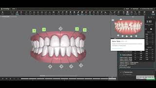 What is a Bolton Discrepancy and how does it relate to IPR Interproximal reduction [upl. by Enelrahc]