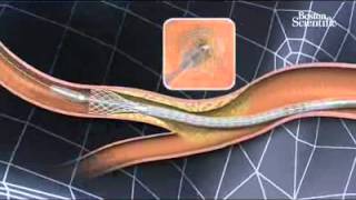 carotid stenting [upl. by Llewop]