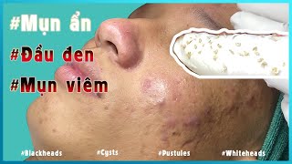 Big Cystic Acne Blackheads Extraction Blackheads amp Milia Whiteheads Removal Pimple Popping [upl. by Nappie]