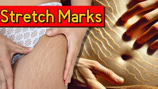 Stretch Marks Striae Explained Causes Risks and Effective Solutions [upl. by Aerda]