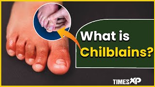 Chilblain What Is it Causes amp Rashes Itching Inflammation On The Skin  TimesXP [upl. by Fremont509]