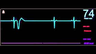 11 Extrasistole ventricular [upl. by Chuu]