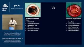 Prosthetic Valve Choice in Heart Valve Surgery [upl. by Ennairda356]