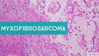 Myxofibrosarcoma 101Explained by a Sarcoma Pathologist [upl. by Onairotciv]