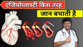 Angioplasty How This Procedure Saves Lives I DR NAVIN AGRAWAL [upl. by Shantha]