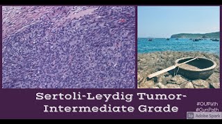 Sertoli Leydig Tumor Moderately Differentiated [upl. by Tabbatha]