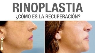 Recuperación de Rinoplastia ¿cómo es  Clínicas Diego de León [upl. by Darlene]