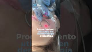 5 beneficios principales de la Microdermoabración  Dr Angélica Domínguez Dermatóloga en bogotá [upl. by Philoo]