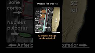 T2weighted image – Anatomy spine Quiz 13 radiologychannel007 [upl. by Aytnahs]