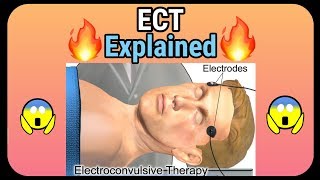 Electroconvulsive therapy ECT explained  How it is performed [upl. by Bekelja743]