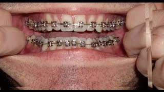 Braces  Photo taken every day  Before and After Transformation  Orthodontics Timelapse [upl. by Vinnie54]