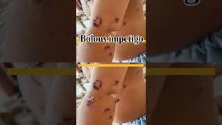 Bolous impetigo Infectious diseases Pediatrics dermatology [upl. by Egor]