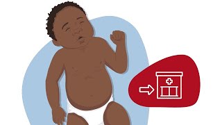 How to Identify Chest Indrawing [upl. by Anisah]