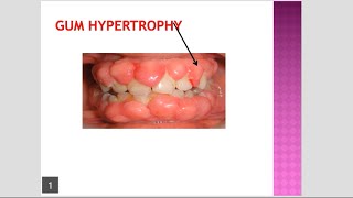 Gum Hypertrophy Gum Hyperplasia due to Phenytoin Amlodipine and Cyclosporine [upl. by Bass]