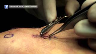 Subcuticular Suture Technique  Hand and Arm Surgery [upl. by Lothair563]