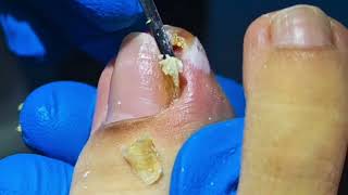 WARNING Dont Try to Remove an Ingrown Toenail Without Watching This [upl. by Nosreg893]