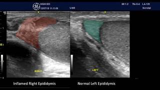 Acute Epididymitis  some PointofCare Ultrasound Features [upl. by Darn]