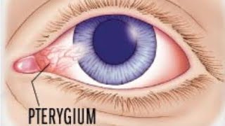 Pterygium  what is pterygium  treatment and surgery options [upl. by Bettina]