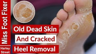 OLD DRY SKIN AND CRACKED HEEL REMOVAL BY MISS FOOT FIXER [upl. by Chamberlain]