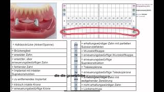 CoverdentureProthesen oder Deckprothesen  HKP abrechnen 14 [upl. by Ahsinak351]