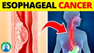 Top 10 Early Warning Signs of Esophageal Cancer  NEVER Ignore THIS [upl. by Attennyl]