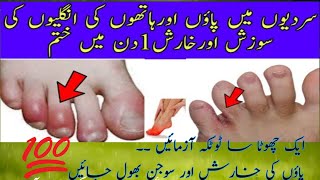 Feet Swelling Treatment Paon ki Sojan Ka ilaj  Chilblains treatment at home  Home Remedies [upl. by Ajani553]