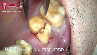 Traumaless extraction for a multiroot tooth [upl. by Simeon]