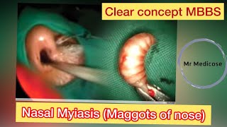 Nasal Myiasis Maggots of nose [upl. by Jennie]