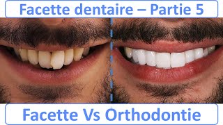 Facette dentaire  Guide complet  Compilation partie 1 à 10 [upl. by Bradway82]