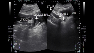 Ultrasound Video showing Two stones in the Ureter [upl. by Maxy]