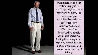 festinating gait  Parkinson [upl. by Kcirddahc]