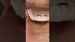 The journey to restoring Anterior Teeth lsk121shorts teeth dental EnvisiontecMain envisiontec [upl. by Glavin373]