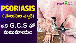 Psoriasis causes amp Treatment Telugu  Skin Infection skincare psoriasis [upl. by Mundy]