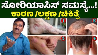 Psoriasis Treatment in Karnataka  Soriyas Disease Treatment Kannada  Nati Vaidya Neelakantha [upl. by Nwahsyt]